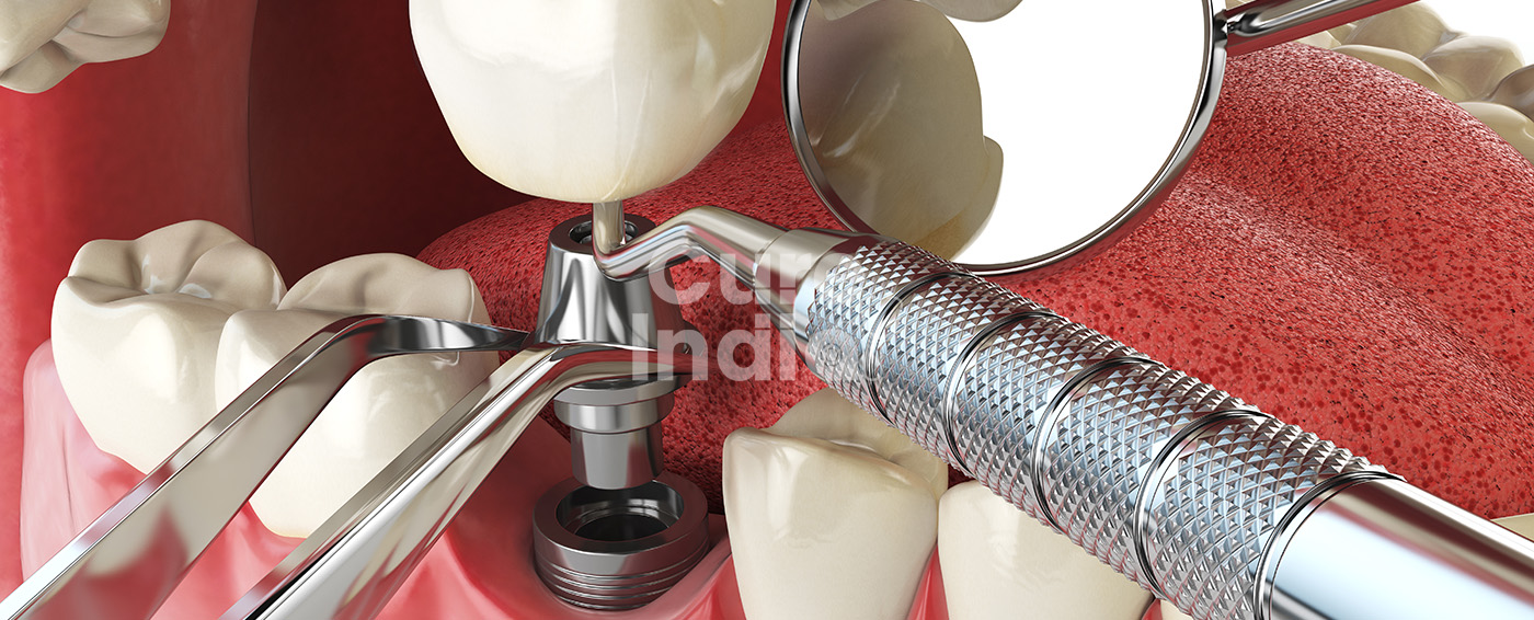 зубной имплант